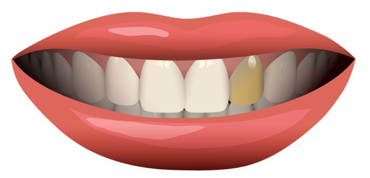 Потемнение зуба