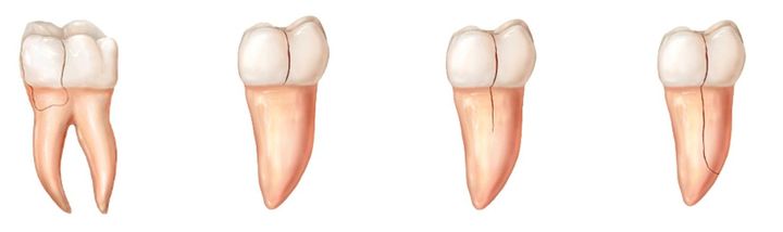 Виды переломов зубов