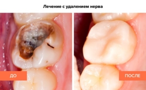 Лечение зуба с удалением нерва
