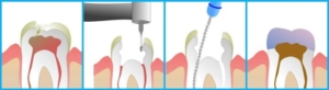 Чистка зубных каналов