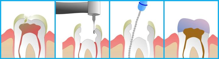 Почему болит зуб после лечения каналов