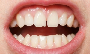 Диастема - щель между зубами