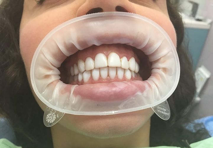 естественное отбеливание зубов air flow