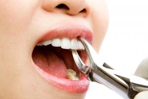 Удаление зуба во время месячных