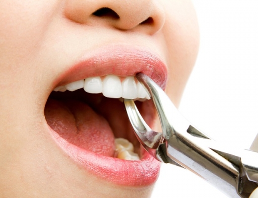 Удаление зуба во время месячных