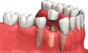 Установка зубного импланта