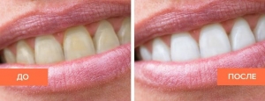 Зубы до и после отбеливания
