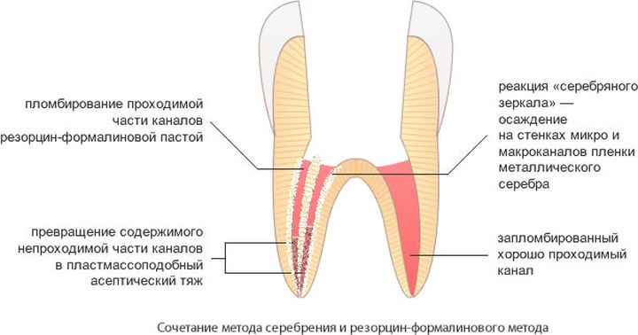 Почему болит резорциненный зуб