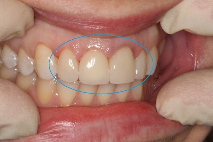 Сепарация зубов при лечение thumbnail