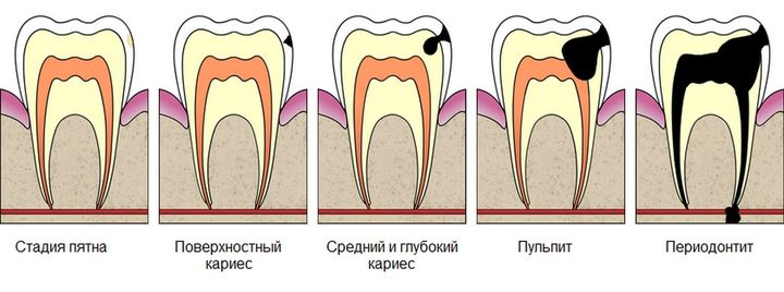 Распорка для зубов при лечении