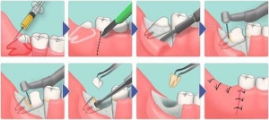 Процесс удаления зуба мудрости и зашивания десны