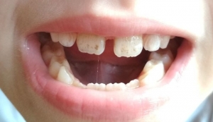 Пятна на эмали молочных зубов