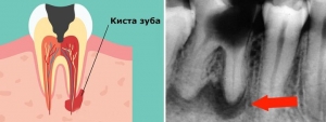 Стандартное расположение зубной кисты