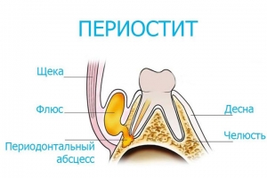 Что такое периостит