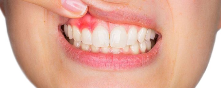 Периостит зуба: симптомы и лечение