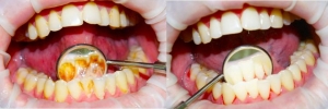 Зубы до и после чистки
