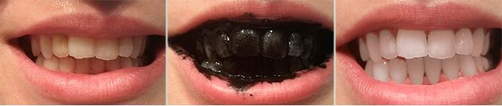 До и после чистки зубов активированным углем