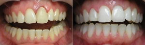 Лечение оголенных корней зубов: фото до и после