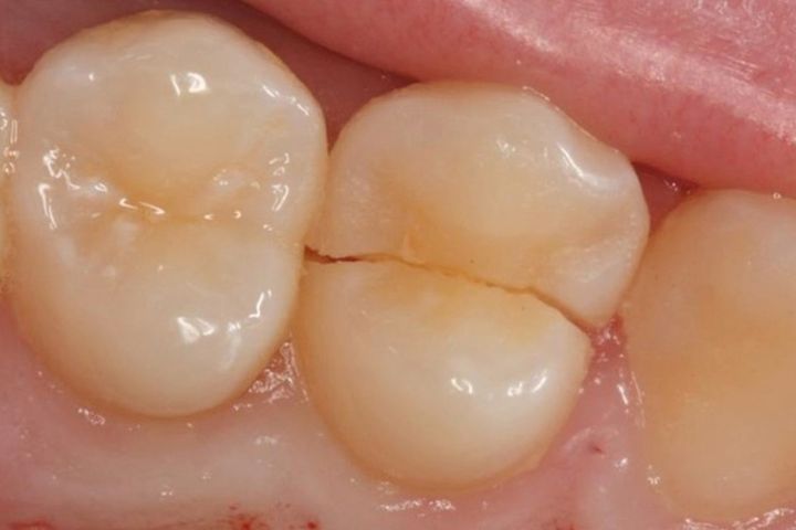 Вертикальная трещина зуба