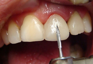 Обработка контура зуба при трещинах
