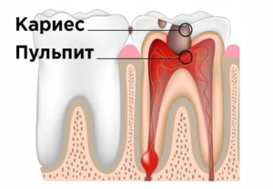 Изображение пульпита